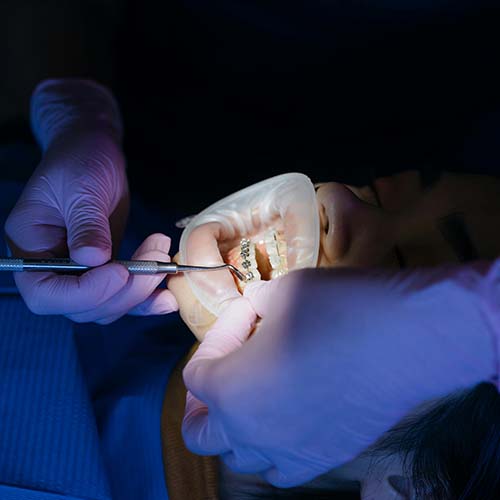 Ağız Kuruluğu → Plak Oluşumu ve Tahriş Olmuş Diş Etleri